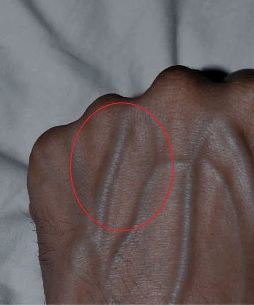 Why Are My Veins Suddenly Bulging and Visible?